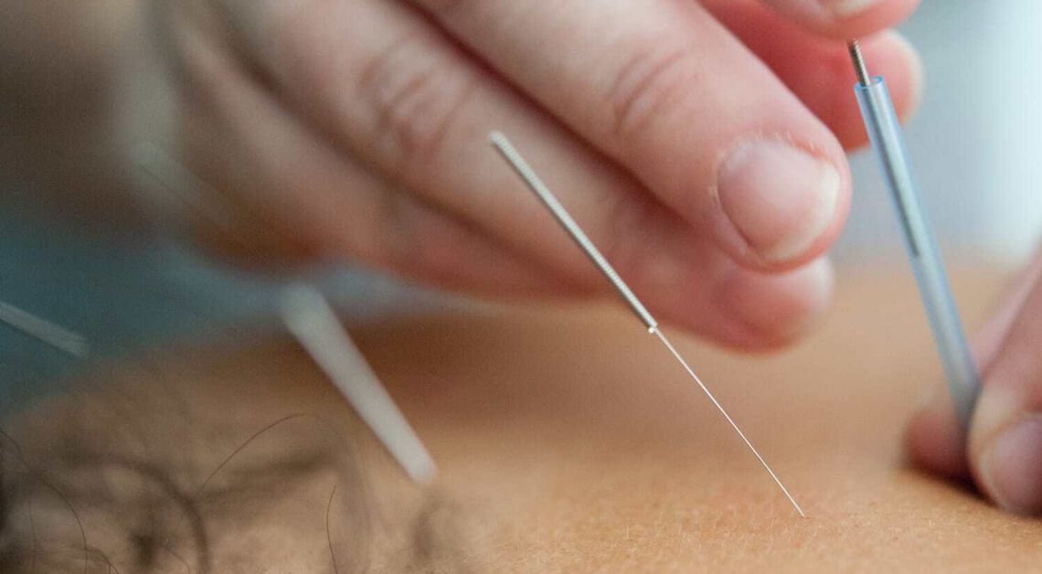 Acupuncture